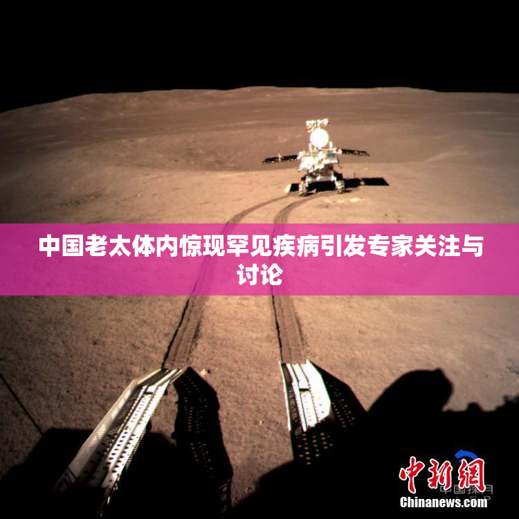 中国老太体内惊现罕见疾病引发专家关注与讨论