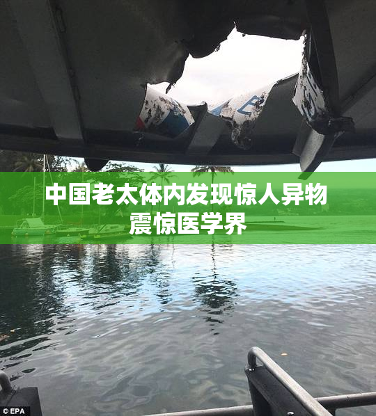 中国老太体内发现惊人异物 震惊医学界